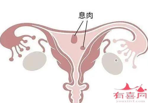 国内哪里可以冻卵：患有子宫内膜息肉可以怀孕吗？(图2)